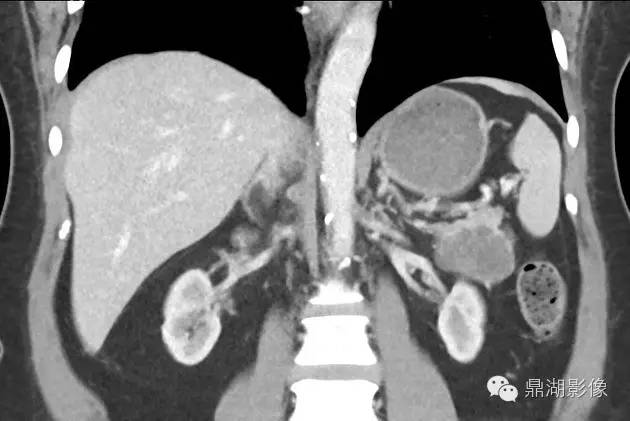 【病例】胰腺浆液性囊腺瘤1例CT影像表现 【病例】胰腺浆液性囊腺瘤1例CT影像表现
