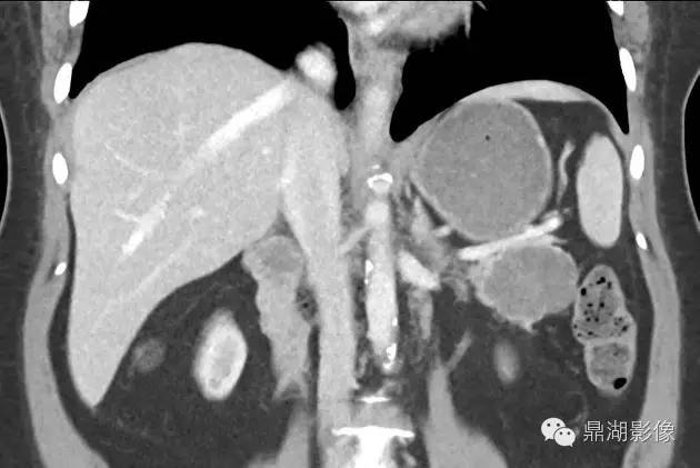 【病例】胰腺浆液性囊腺瘤1例CT影像表现 【病例】胰腺浆液性囊腺瘤1例CT影像表现
