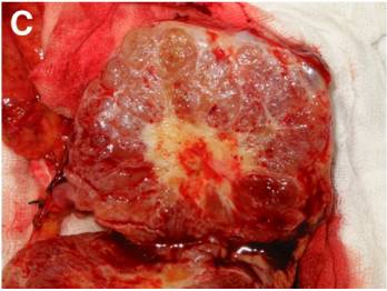 【病例】胰腺浆液性囊腺瘤1例CT影像表现 【病例】胰腺浆液性囊腺瘤1例CT影像表现