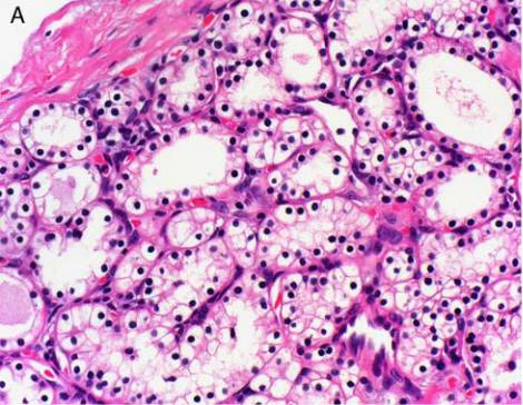 【病例】胰腺浆液性囊腺瘤1例CT影像表现 【病例】胰腺浆液性囊腺瘤1例CT影像表现