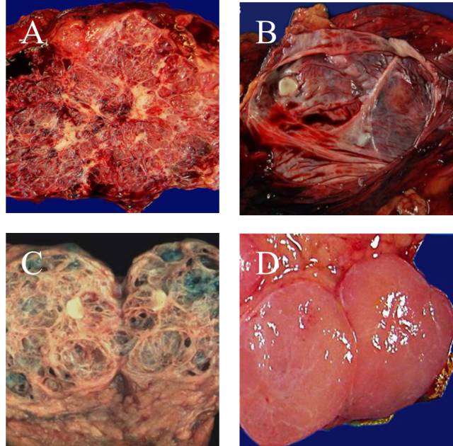 【病例】胰腺浆液性囊腺瘤1例CT影像表现 【病例】胰腺浆液性囊腺瘤1例CT影像表现