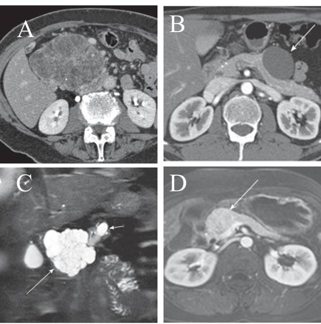 【病例】胰腺浆液性囊腺瘤1例CT影像表现