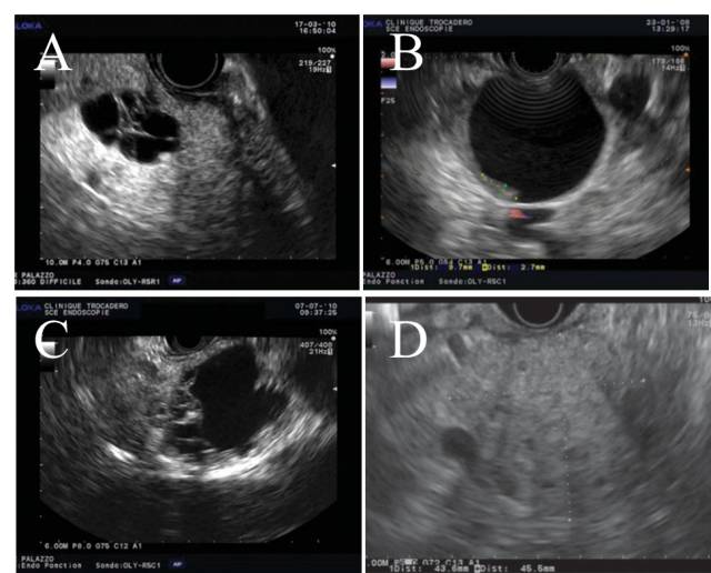 【病例】胰腺浆液性囊腺瘤1例CT影像表现 【病例】胰腺浆液性囊腺瘤1例CT影像表现