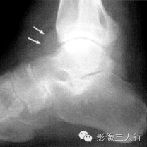 "踝关节泪滴征"，这个征象提示啥？