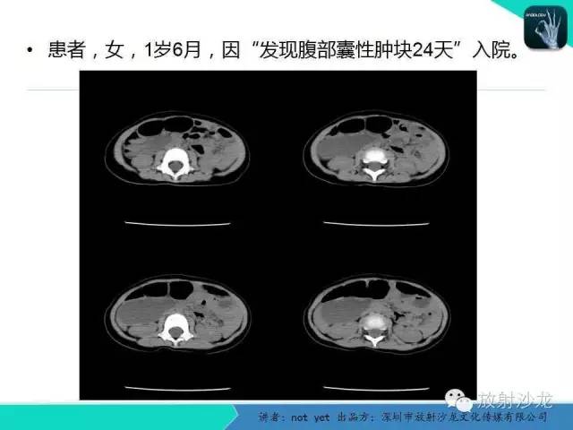 【病例】小肠重复畸形1例CT影像表现