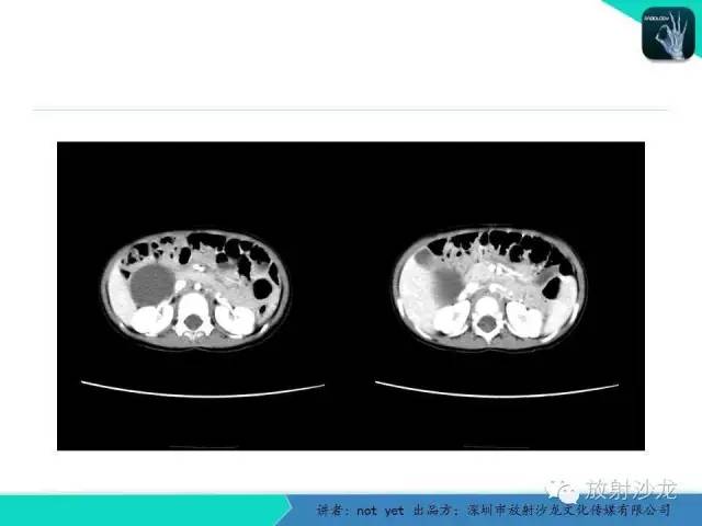 【病例】小肠重复畸形1例CT影像表现