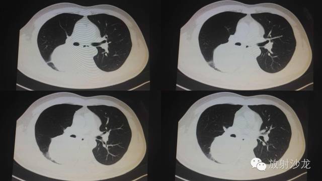 【病例】硬化性血管瘤1例CT影像讨论 【病例】硬化性血管瘤1例CT影像讨论