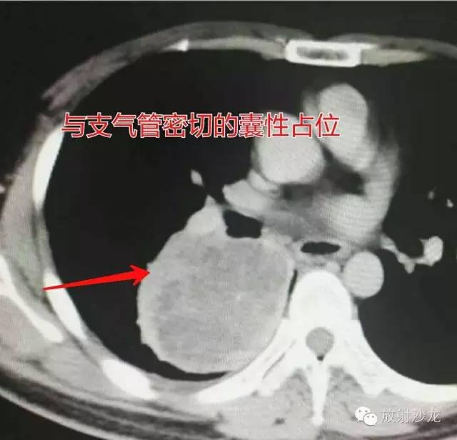 【病例】硬化性血管瘤1例CT影像讨论 【病例】硬化性血管瘤1例CT影像讨论