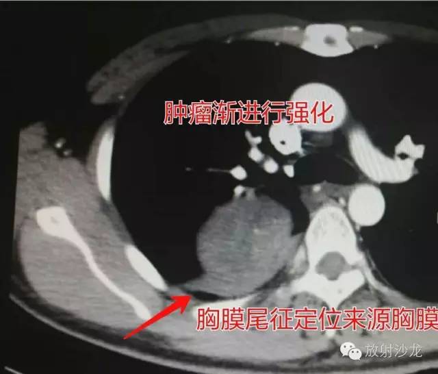 【病例】硬化性血管瘤1例CT影像讨论 【病例】硬化性血管瘤1例CT影像讨论