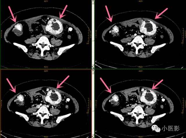【病例】卵巢浆液性乳头状腺癌腹腔钙化性转移1例CT 【病例】卵巢浆液性乳头状腺癌腹腔钙化性转移1例CT
