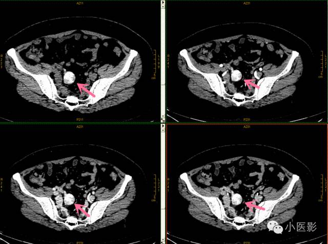 【病例】卵巢浆液性乳头状腺癌腹腔钙化性转移1例CT 【病例】卵巢浆液性乳头状腺癌腹腔钙化性转移1例CT