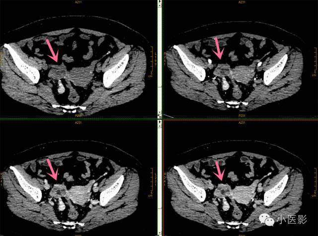 【病例】卵巢浆液性乳头状腺癌腹腔钙化性转移1例CT 【病例】卵巢浆液性乳头状腺癌腹腔钙化性转移1例CT