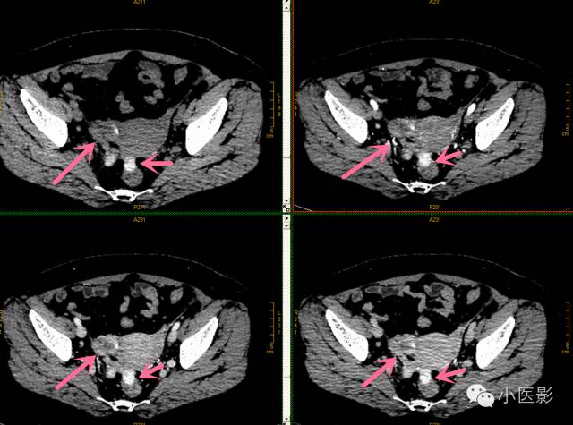 【病例】卵巢浆液性乳头状腺癌腹腔钙化性转移1例CT 【病例】卵巢浆液性乳头状腺癌腹腔钙化性转移1例CT
