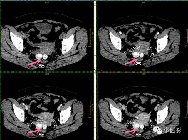 【病例】卵巢浆液性乳头状腺癌腹腔钙化性转移1例CT 【病例】卵巢浆液性乳头状腺癌腹腔钙化性转移1例CT
