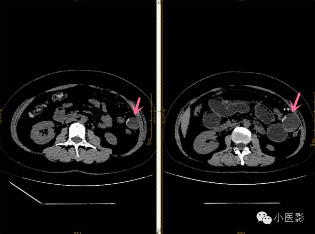 【病例】卵巢浆液性乳头状腺癌腹腔钙化性转移1例CT 【病例】卵巢浆液性乳头状腺癌腹腔钙化性转移1例CT