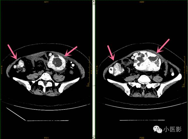 【病例】卵巢浆液性乳头状腺癌腹腔钙化性转移1例CT 【病例】卵巢浆液性乳头状腺癌腹腔钙化性转移1例CT
