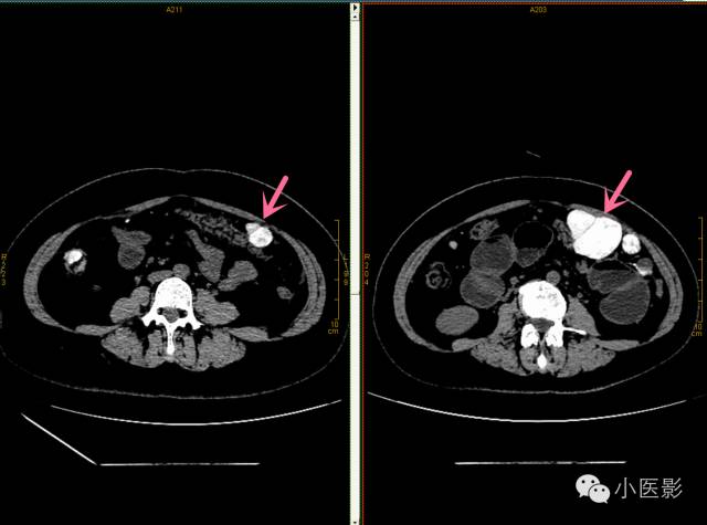 【病例】卵巢浆液性乳头状腺癌腹腔钙化性转移1例CT 【病例】卵巢浆液性乳头状腺癌腹腔钙化性转移1例CT