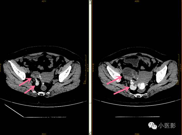 【病例】卵巢浆液性乳头状腺癌腹腔钙化性转移1例CT 【病例】卵巢浆液性乳头状腺癌腹腔钙化性转移1例CT
