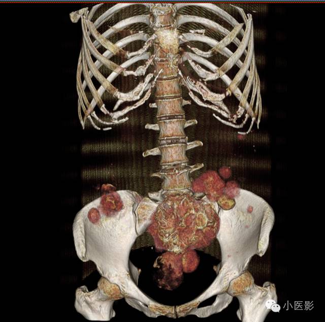 【病例】卵巢浆液性乳头状腺癌腹腔钙化性转移1例CT 【病例】卵巢浆液性乳头状腺癌腹腔钙化性转移1例CT