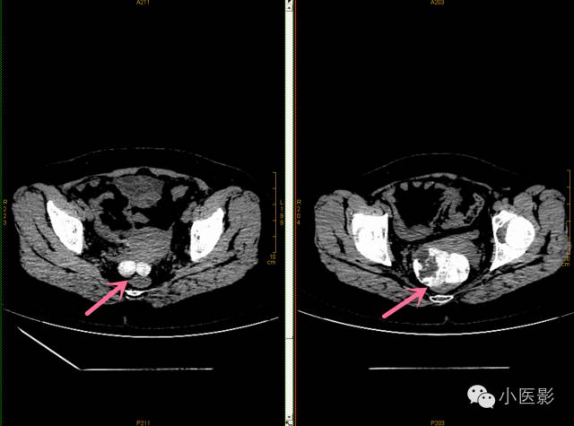 【病例】卵巢浆液性乳头状腺癌腹腔钙化性转移1例CT 【病例】卵巢浆液性乳头状腺癌腹腔钙化性转移1例CT