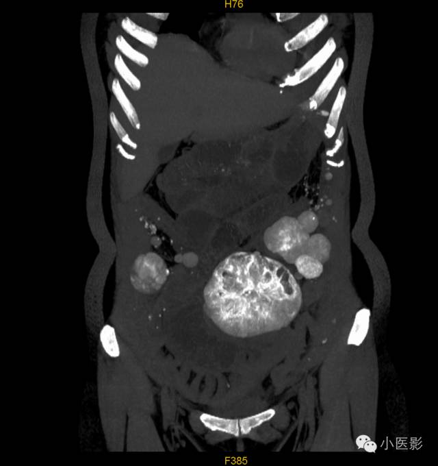 【病例】卵巢浆液性乳头状腺癌腹腔钙化性转移1例CT 【病例】卵巢浆液性乳头状腺癌腹腔钙化性转移1例CT