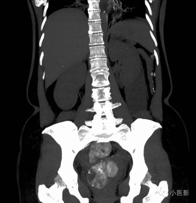 【病例】卵巢浆液性乳头状腺癌腹腔钙化性转移1例CT 【病例】卵巢浆液性乳头状腺癌腹腔钙化性转移1例CT