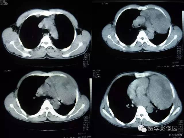 【病例】胸腺类癌1例CT影像表现