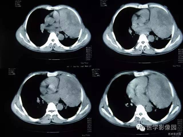 【病例】胸腺类癌1例CT影像表现