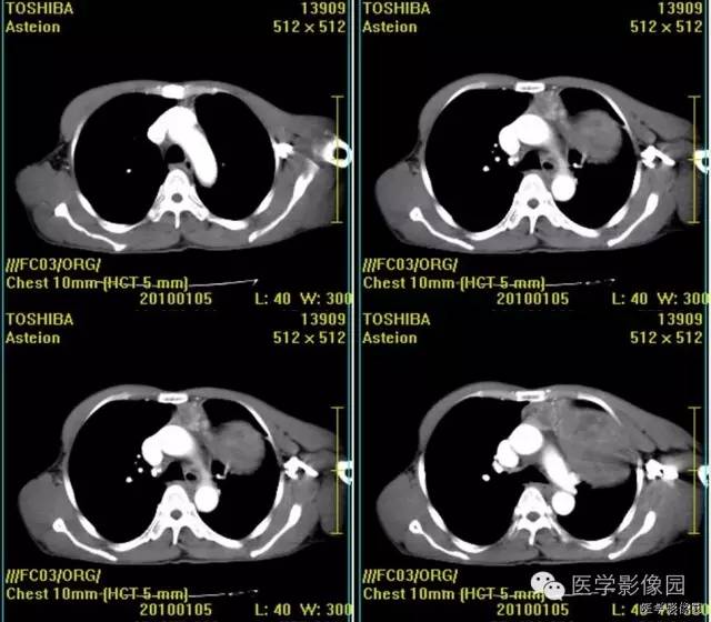 【病例】胸腺类癌1例CT影像表现