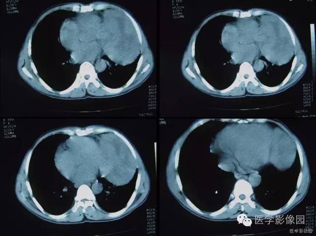 【病例】胸腺类癌1例CT影像表现