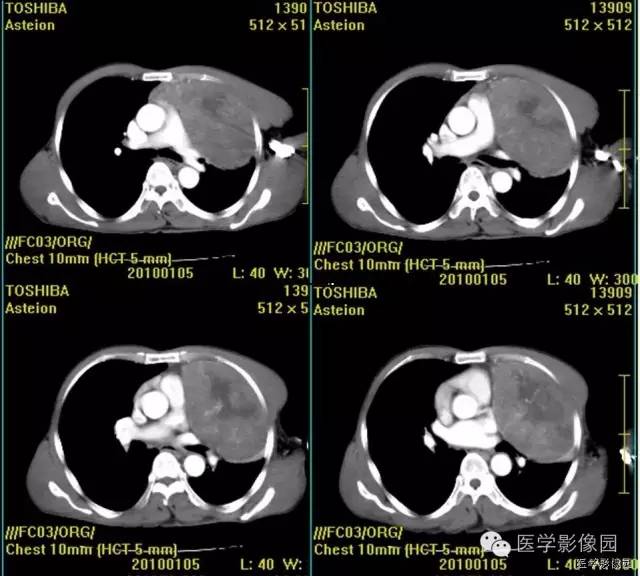 【病例】胸腺类癌1例CT影像表现
