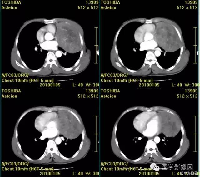 【病例】胸腺类癌1例CT影像表现