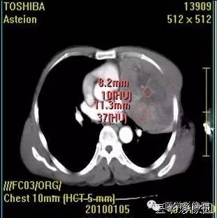 【病例】胸腺类癌1例CT影像表现