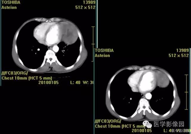 【病例】胸腺类癌1例CT影像表现