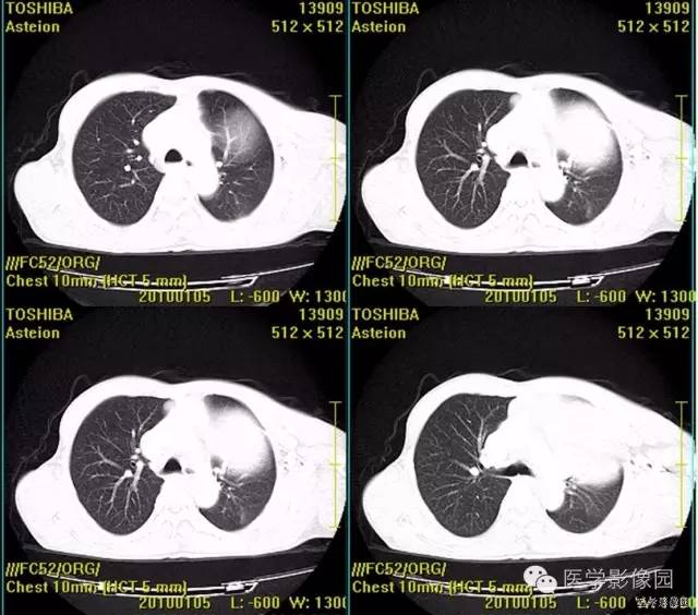 【病例】胸腺类癌1例CT影像表现