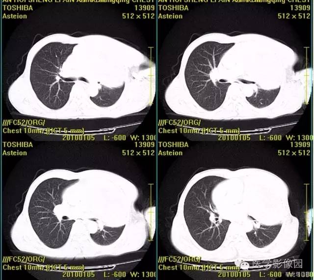 【病例】胸腺类癌1例CT影像表现