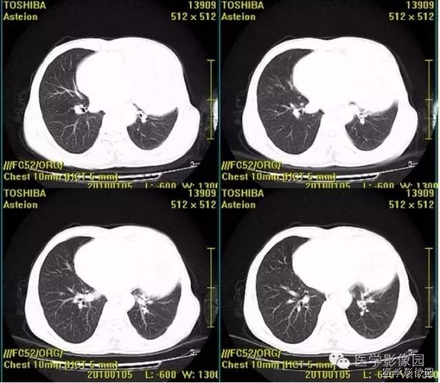 【病例】胸腺类癌1例CT影像表现