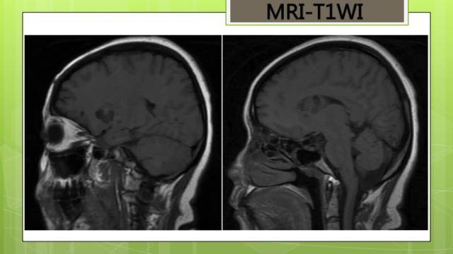 【病例】脑播散性隐球菌病1例MR影像表现