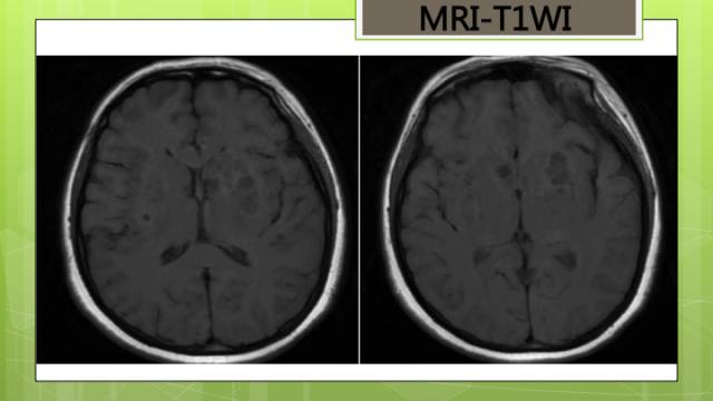 【病例】脑播散性隐球菌病1例MR影像表现
