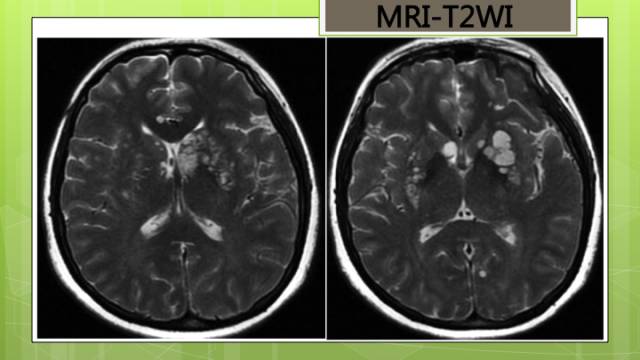 【病例】脑播散性隐球菌病1例MR影像表现
