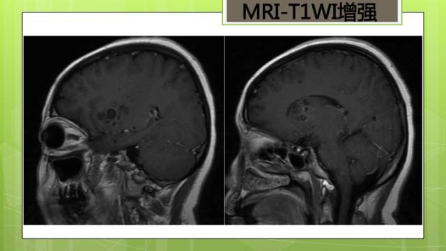 【病例】脑播散性隐球菌病1例MR影像表现