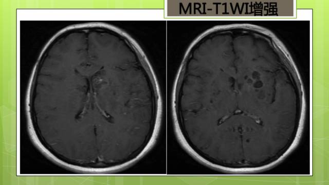 【病例】脑播散性隐球菌病1例MR影像表现