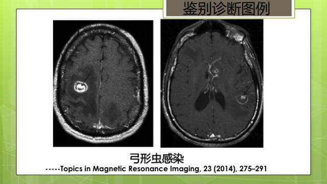 【病例】脑播散性隐球菌病1例MR影像表现