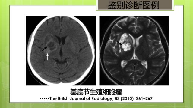 【病例】脑播散性隐球菌病1例MR影像表现