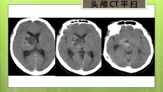 【病例】右侧基底节区生殖细胞瘤1例CT及MR影像表现