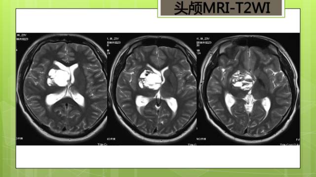 【病例】右侧基底节区生殖细胞瘤1例CT及MR影像表现