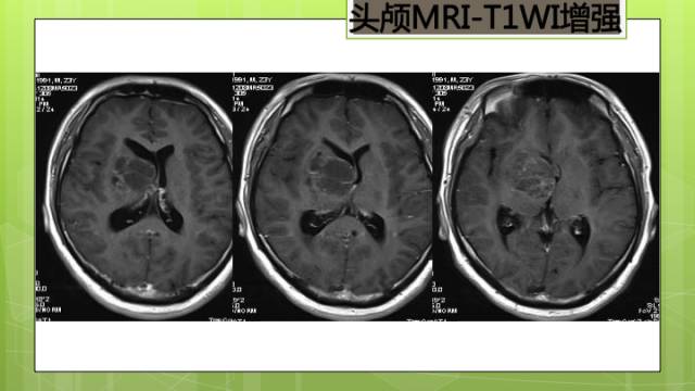 【病例】右侧基底节区生殖细胞瘤1例CT及MR影像表现