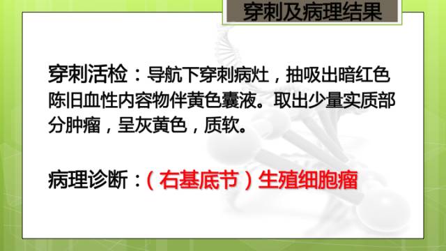 【病例】右侧基底节区生殖细胞瘤1例CT及MR影像表现