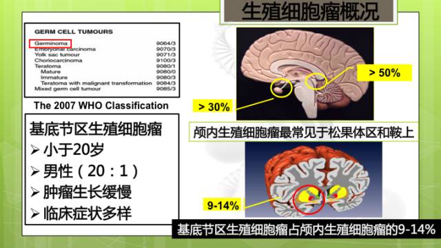 【病例】右侧基底节区生殖细胞瘤1例CT及MR影像表现