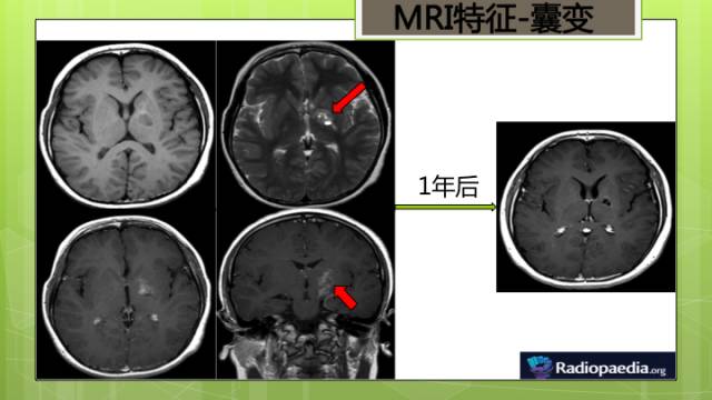 【病例】右侧基底节区生殖细胞瘤1例CT及MR影像表现